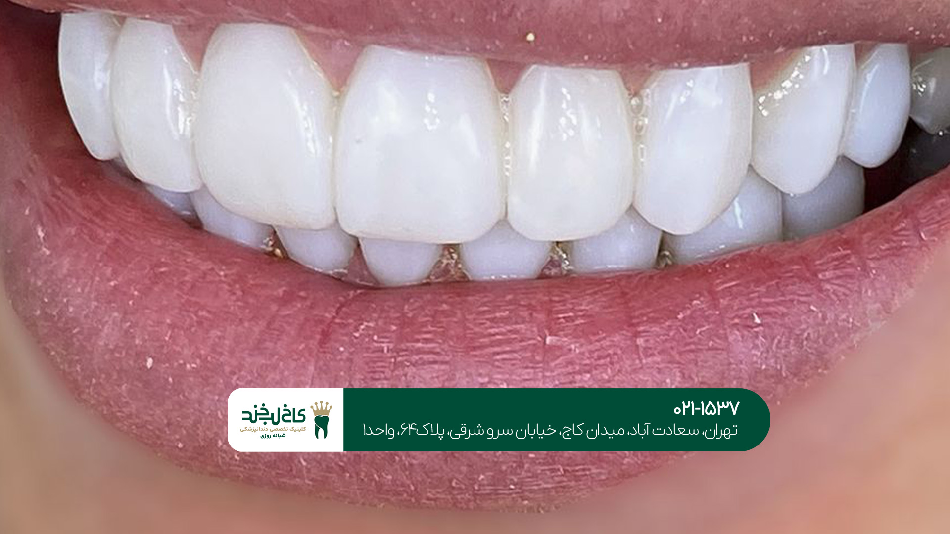 بهترین کلینیک کامپوزیت