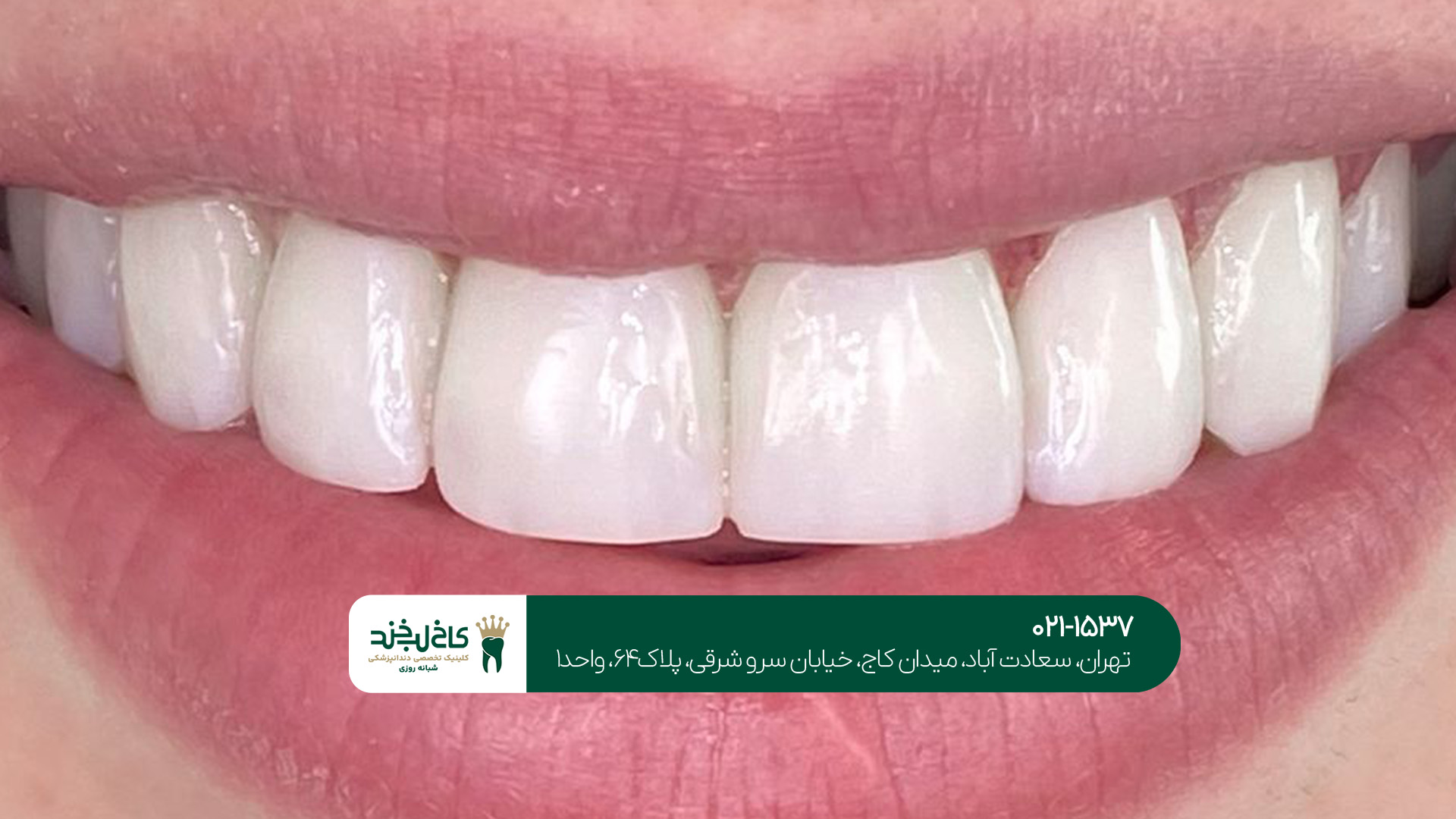 بهترین کلینیک کامپوزیت