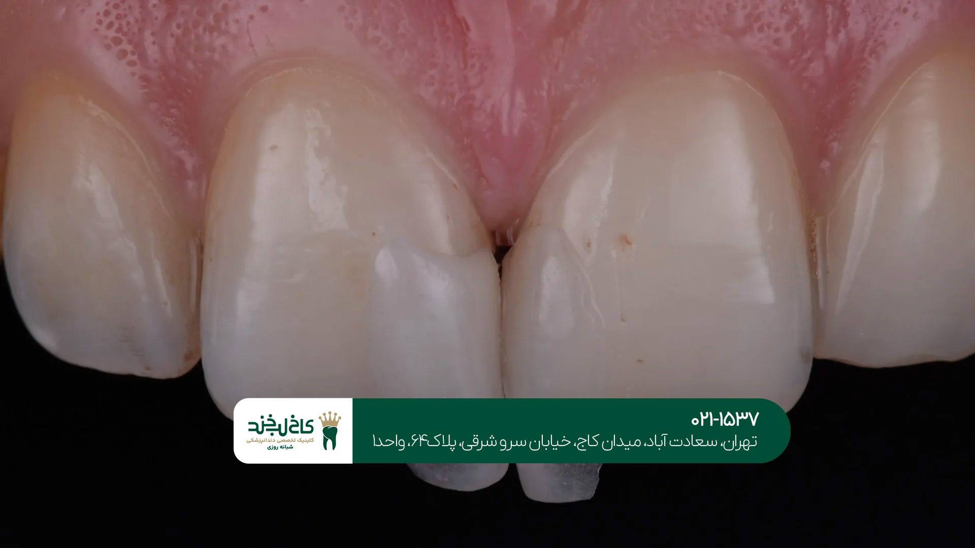 بهترین دندانپزشکی لمینت دندان تهران بهترین دندانپزشکی لمینت دندان تهران