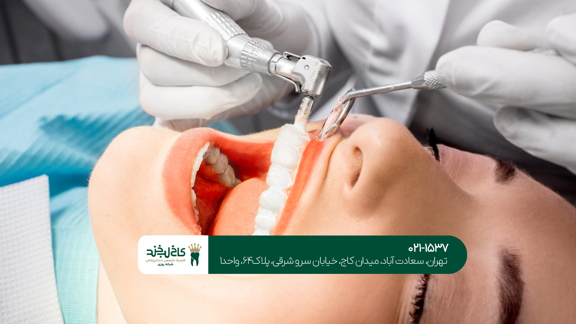 بلیچینگ دندان