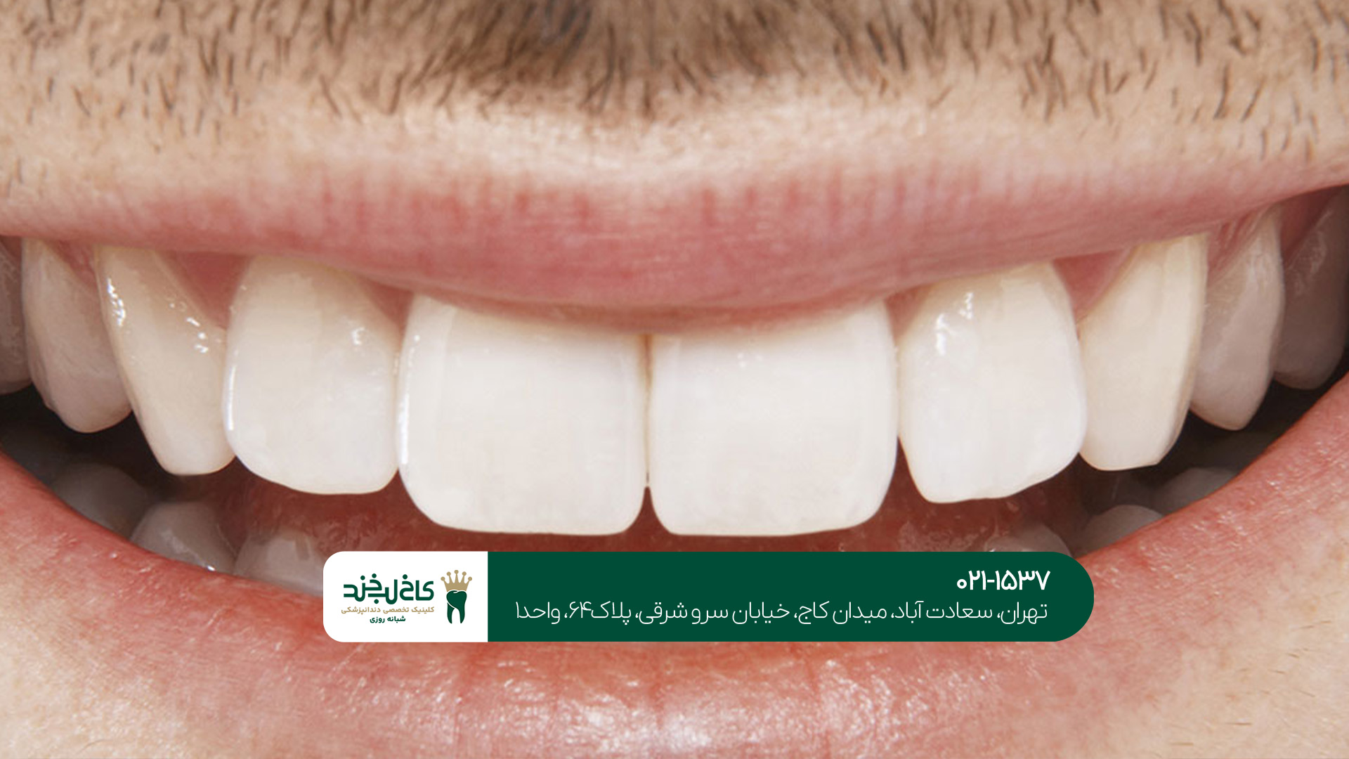 بهترین کلینیک لمینت و کامپوزیت تهران بهترین کلینیک لمینت و کامپوزیت تهران