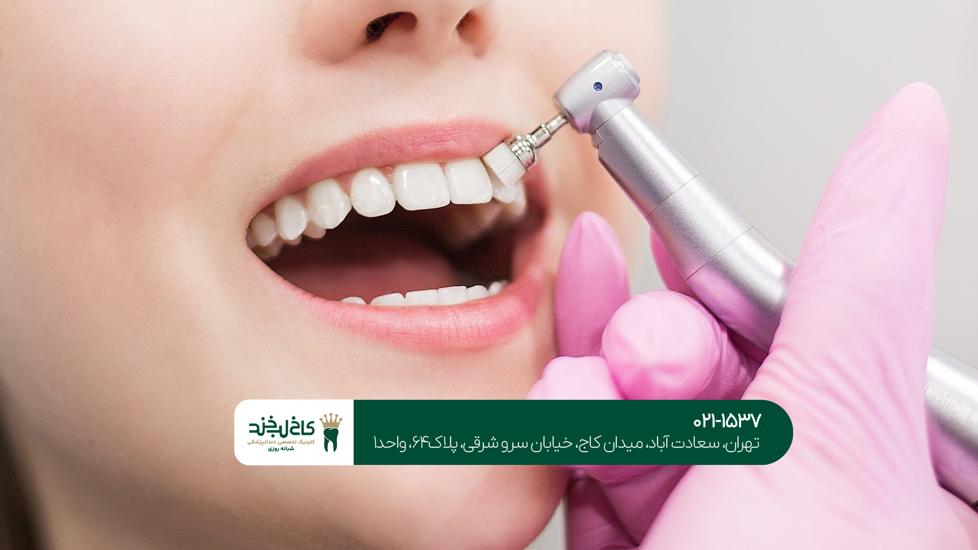 جرم‌گیری دندان در شمال تهران