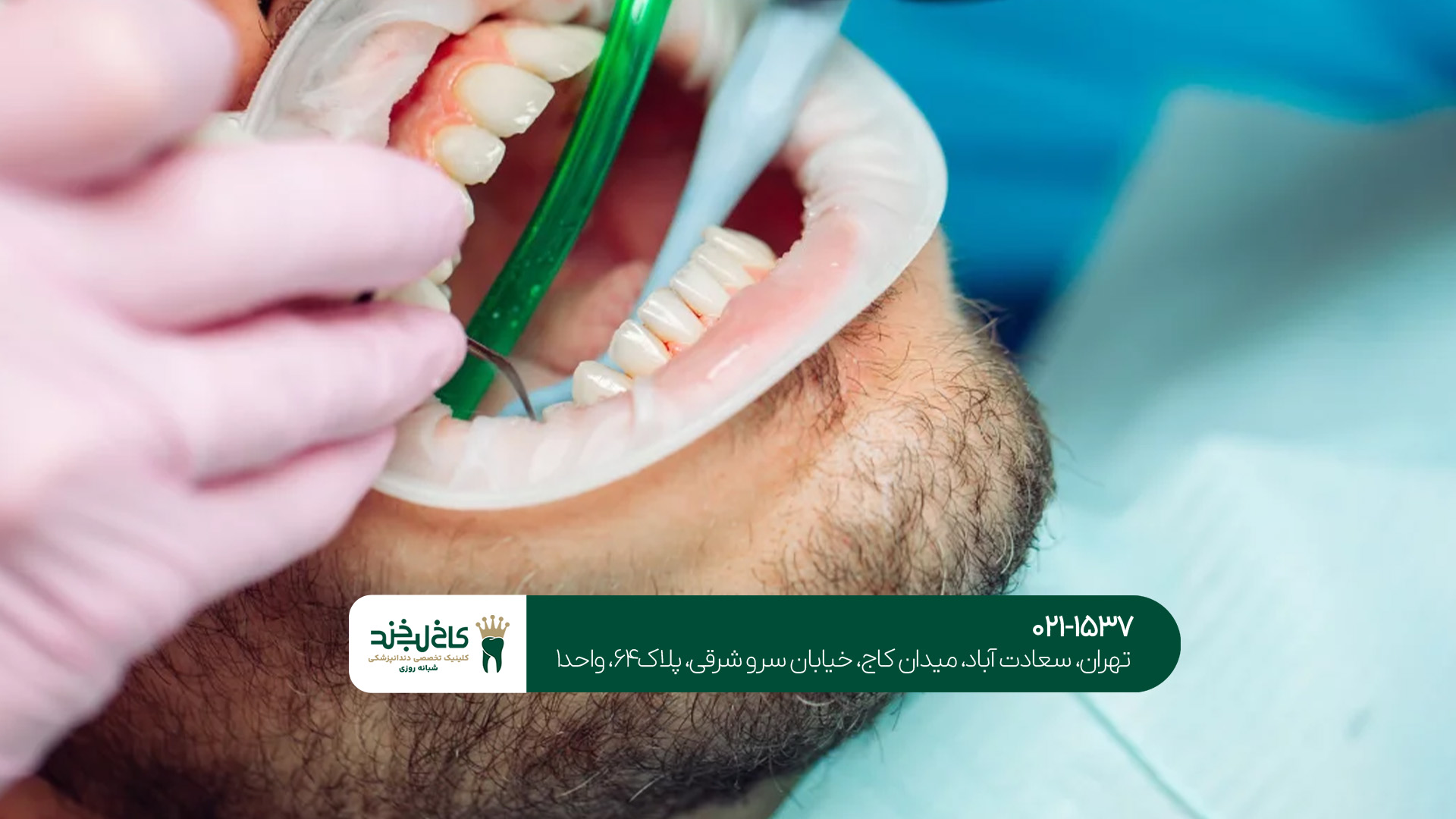 جرم‌گیری دندان در شمال تهران