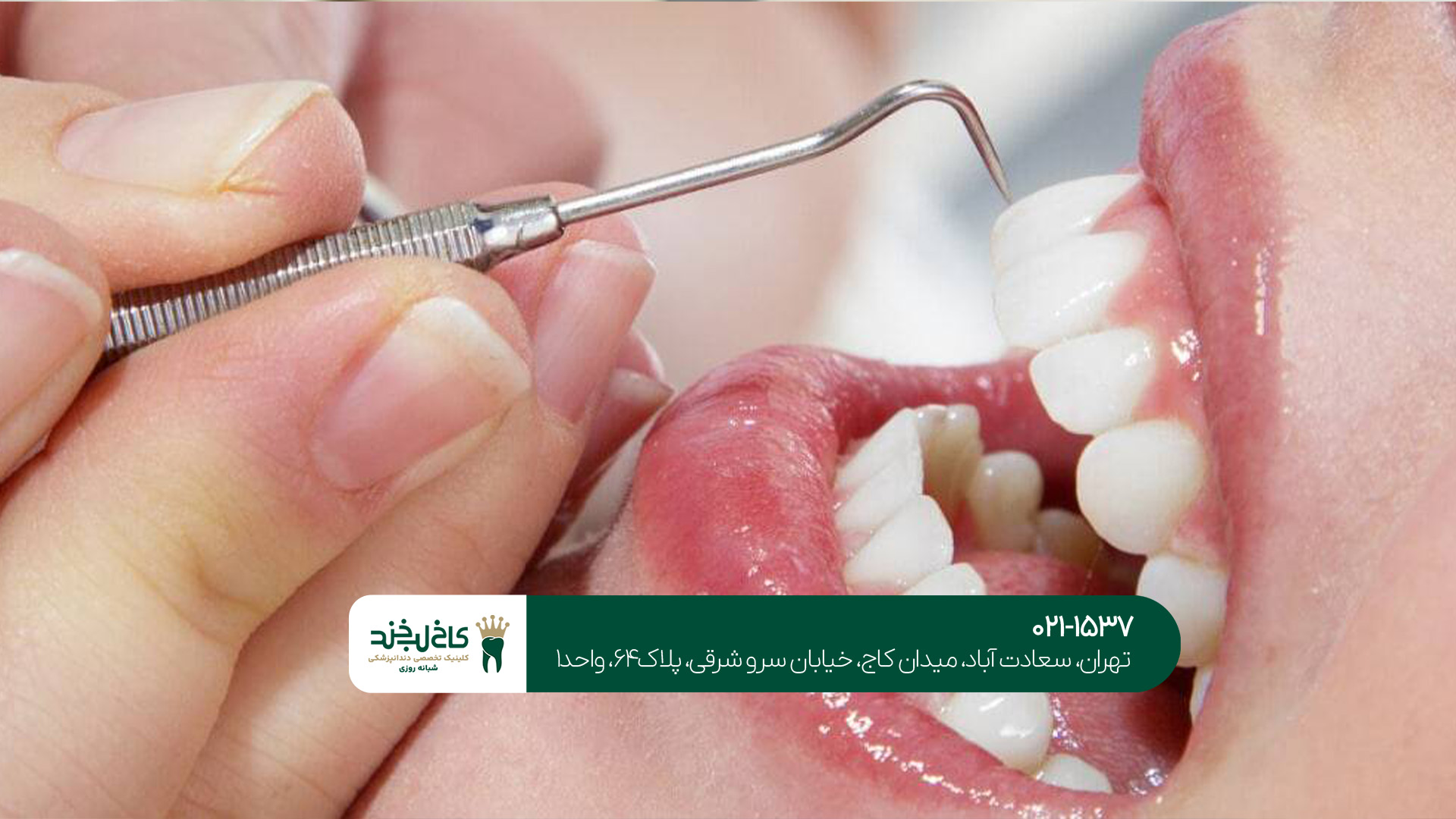 جرم‌گیری دندان در شمال تهران