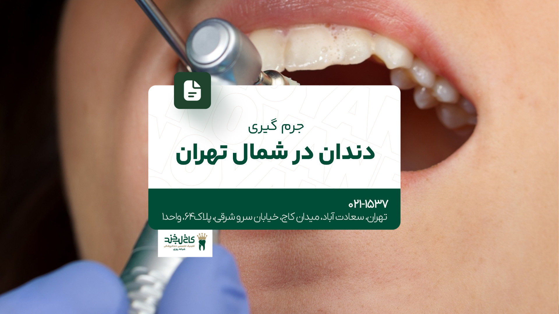 جرم‌گیری دندان در شمال تهران