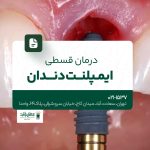 درمان قسطی ایمپلنت دندان