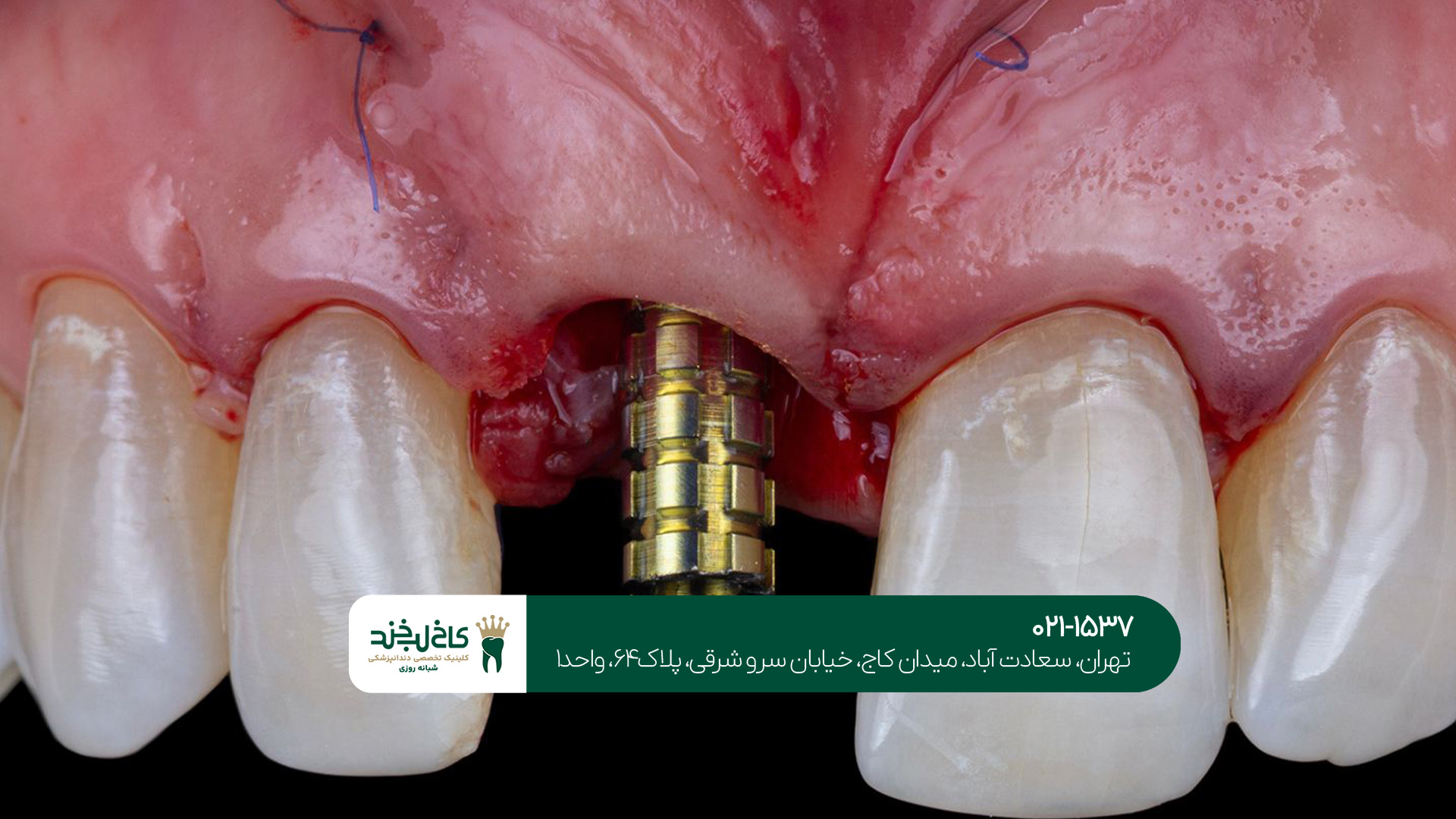 درمان قسطی ایمپلنت دندان
