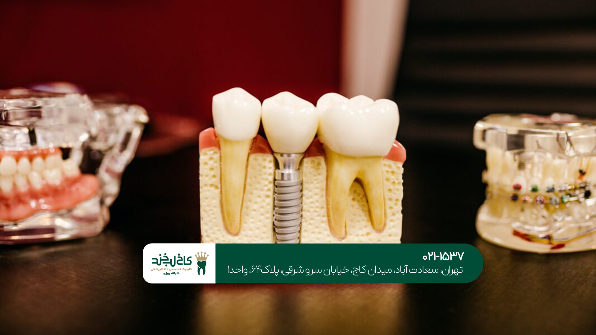 درمان قسطی ایمپلنت دندان