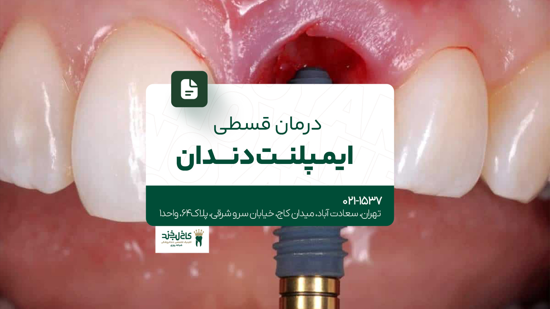 درمان قسطی ایمپلنت دندان