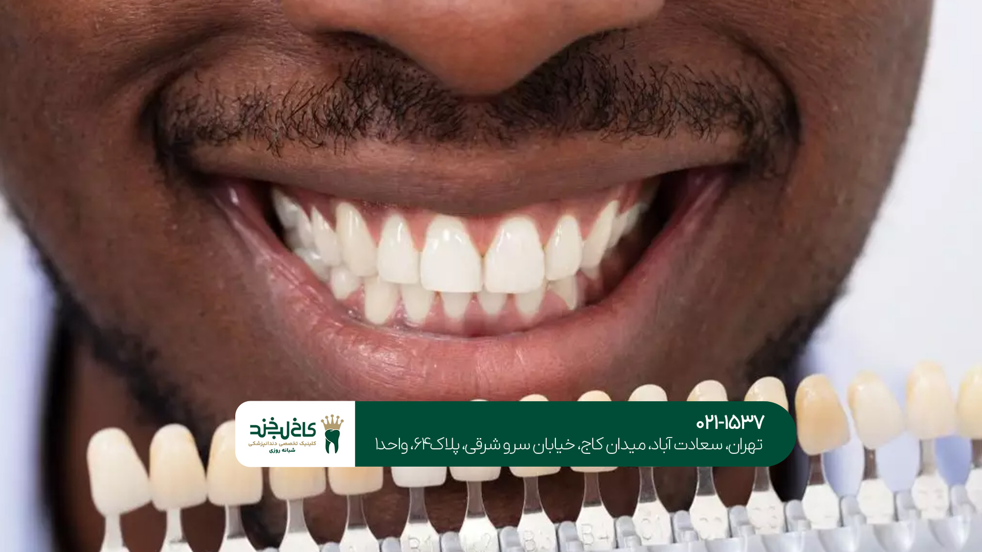 شرایط اقساطی لمینت و کامپوزیت در تهران