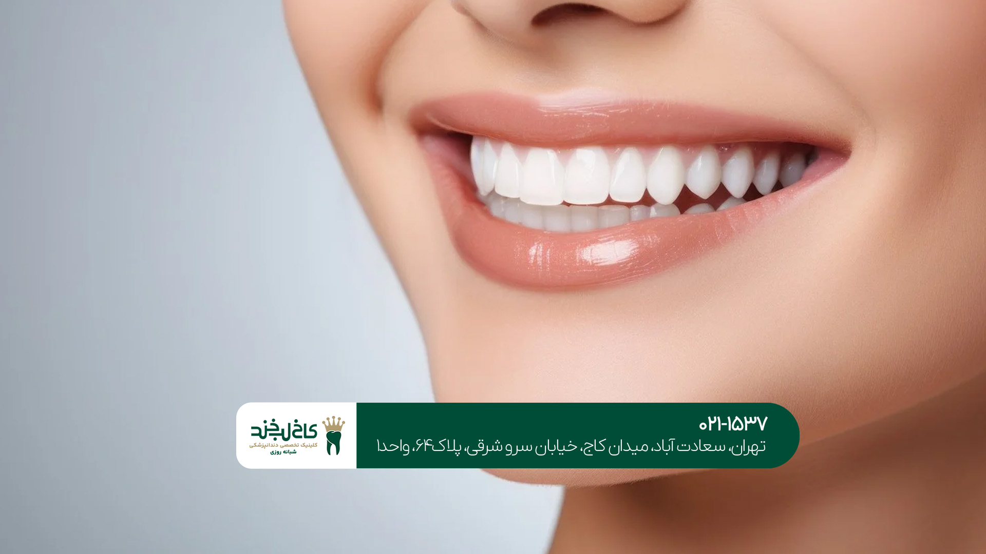 شرایط اقساطی لمینت و کامپوزیت در تهران