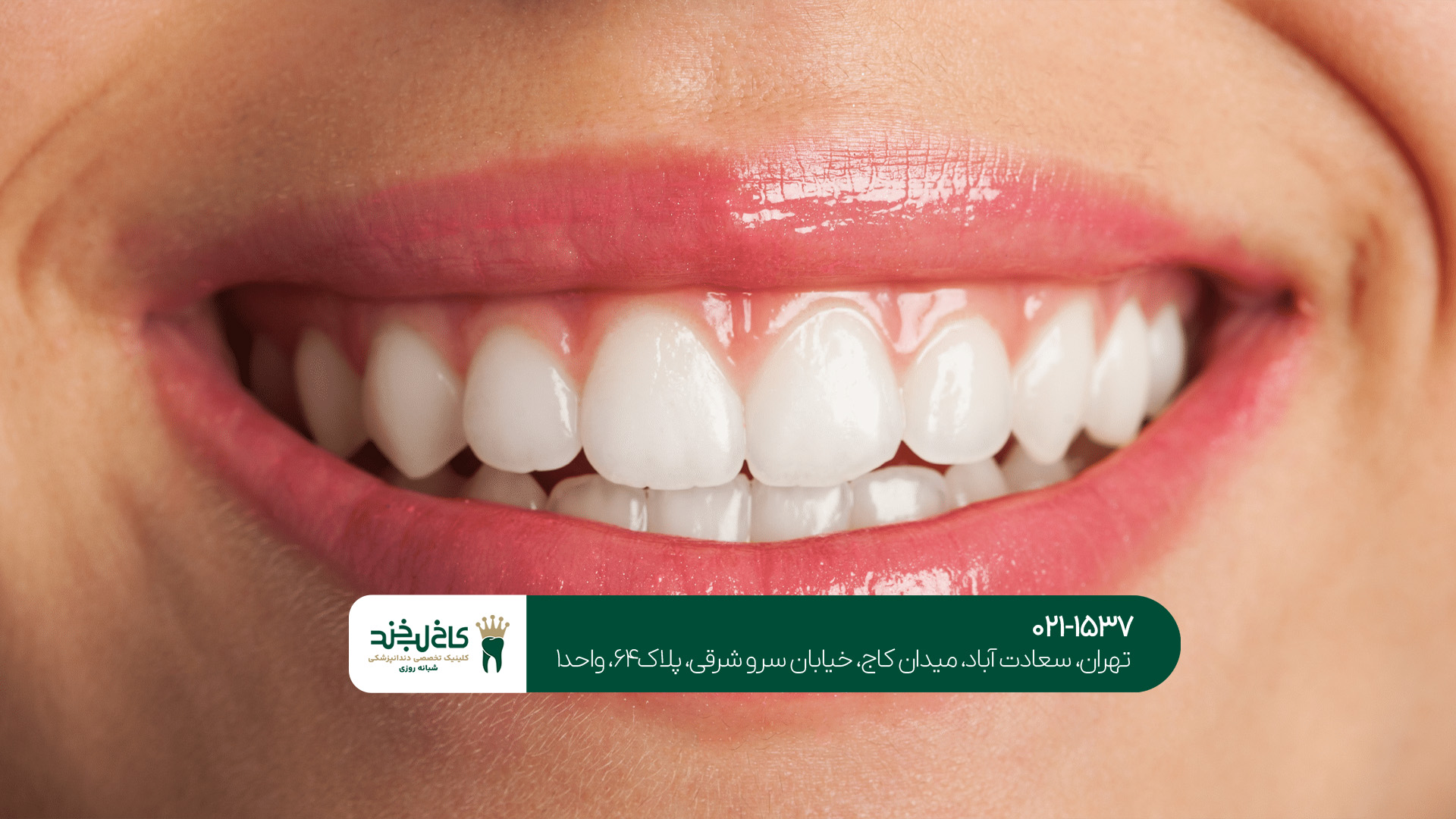 شرایط اقساطی لمینت و کامپوزیت در تهران