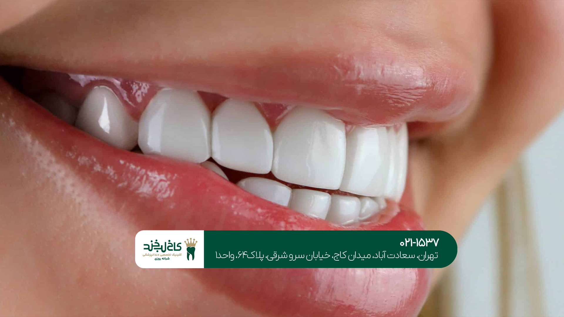 لمینت دندان حرفه ای لمینت دندان حرفه ای