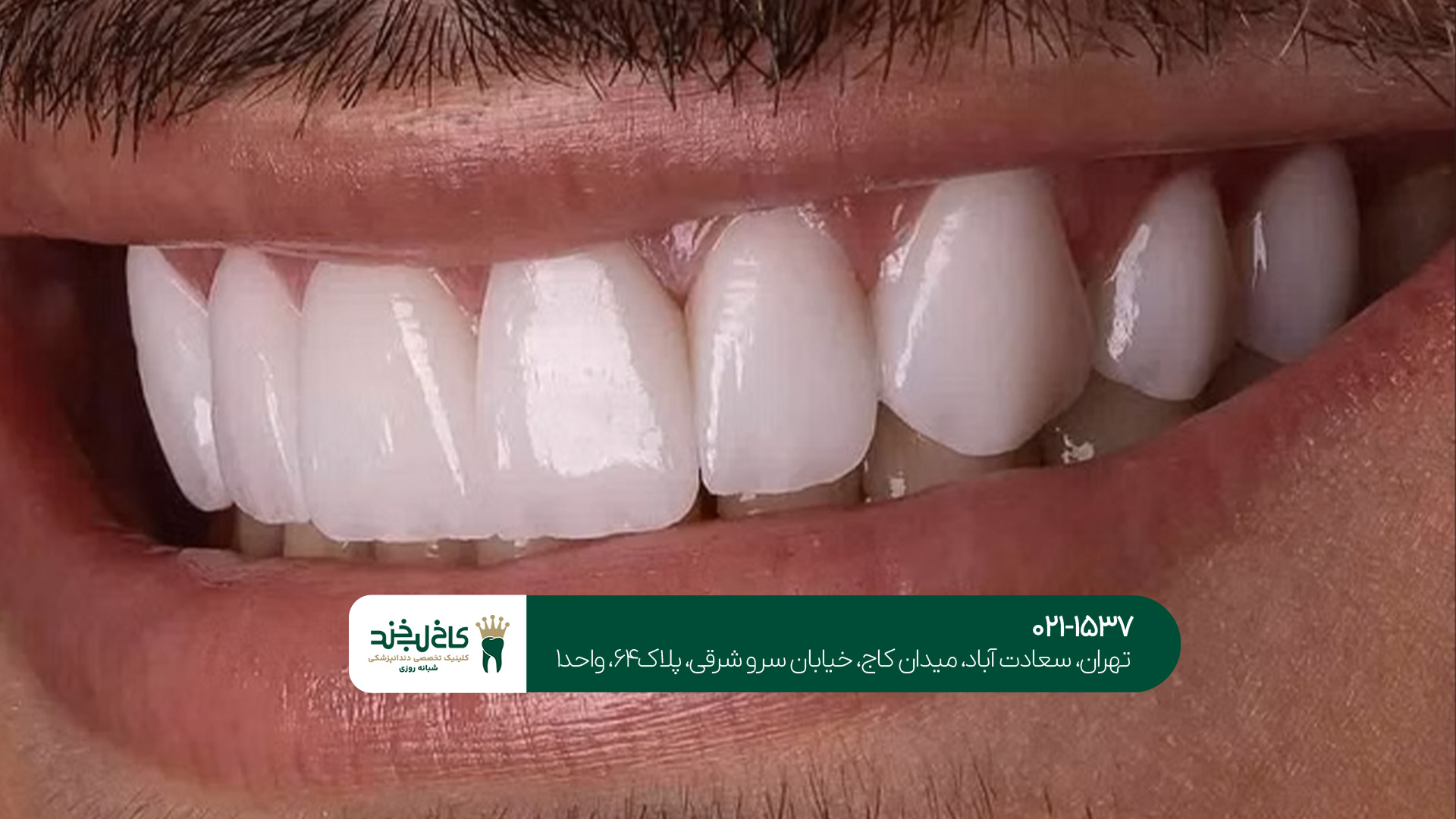 لمینت دندان حرفه ای لمینت دندان حرفه ای