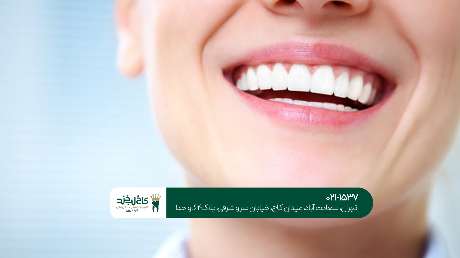 لمینت دندان حرفه ای لمینت دندان حرفه ای