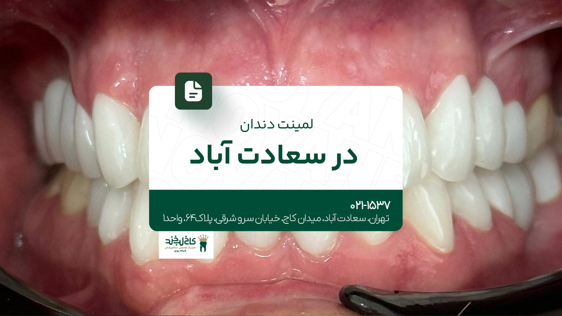 لمینت دندان در سعادتآباد لمینت دندان در سعادتآباد