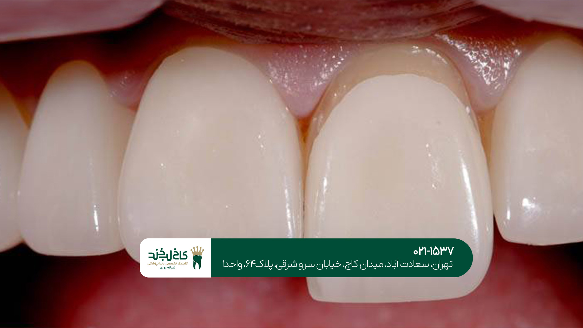 لمینت دندان در سعادتآباد لمینت دندان در سعادتآباد