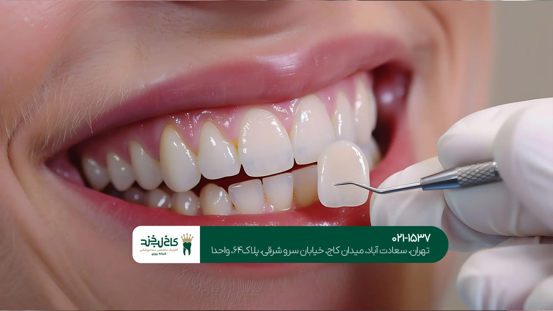 لمینت دندان در سعادتآباد لمینت دندان در سعادتآباد