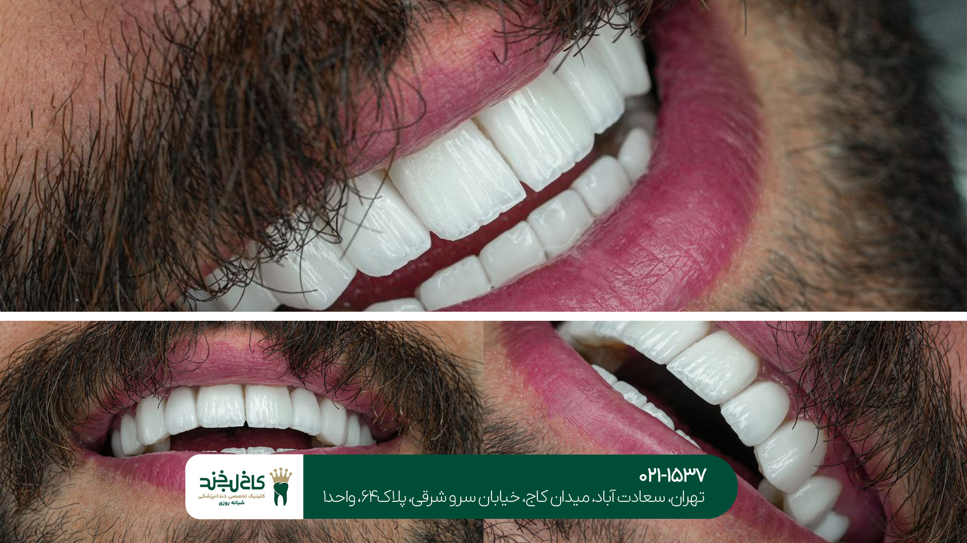 لمینت دندان