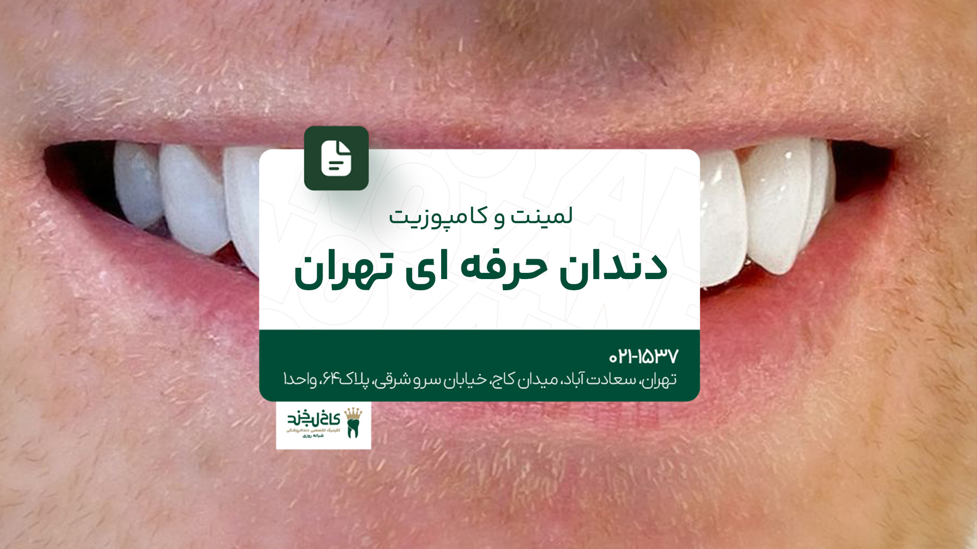 لمینت و کامپوزیت دندان حرفهای تهران لمینت و کامپوزیت دندان حرفهای تهران