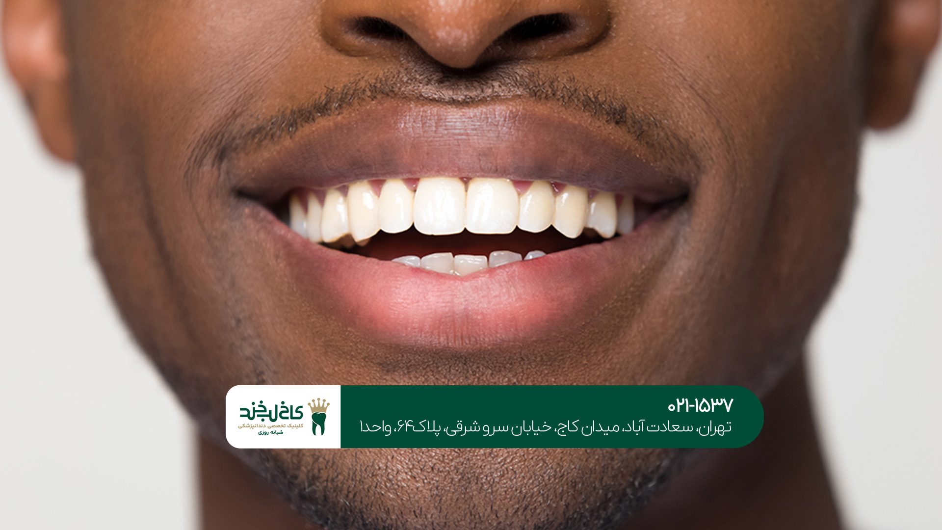 لمینت و کامپوزیت دندان حرفهای تهران لمینت و کامپوزیت دندان حرفهای تهران