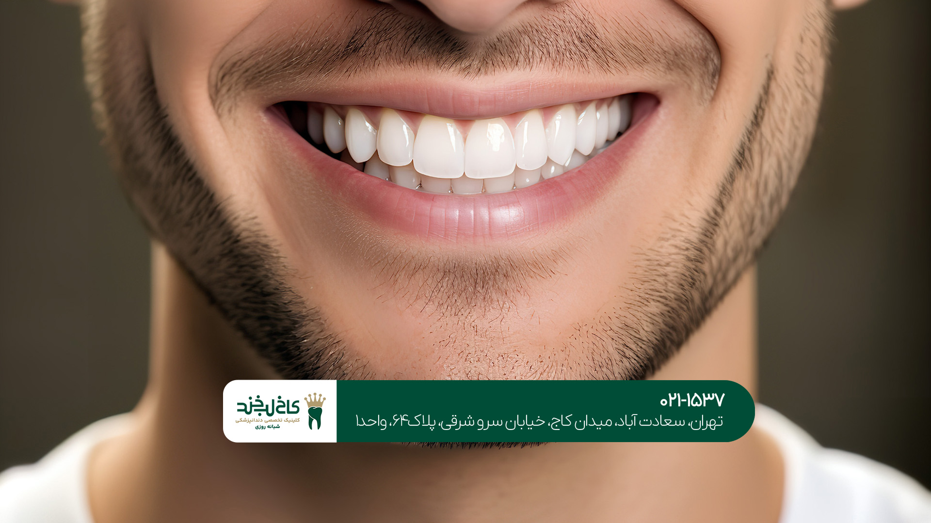 لمینت و کامپوزیت دندان حرفهای تهران لمینت و کامپوزیت دندان حرفهای تهران