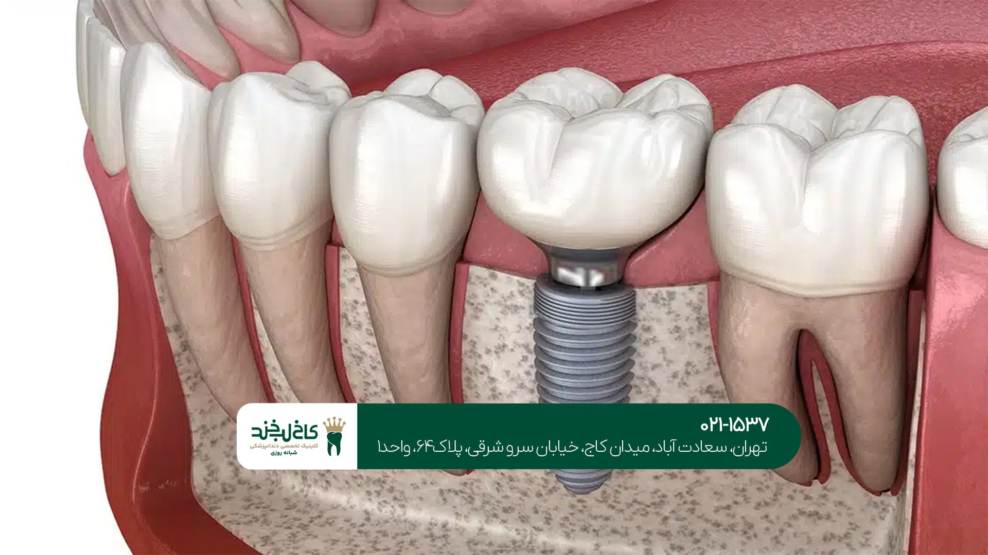 مراقبتهای بعد از ایمپلنت دندان مراقبتهای بعد از ایمپلنت دندان
