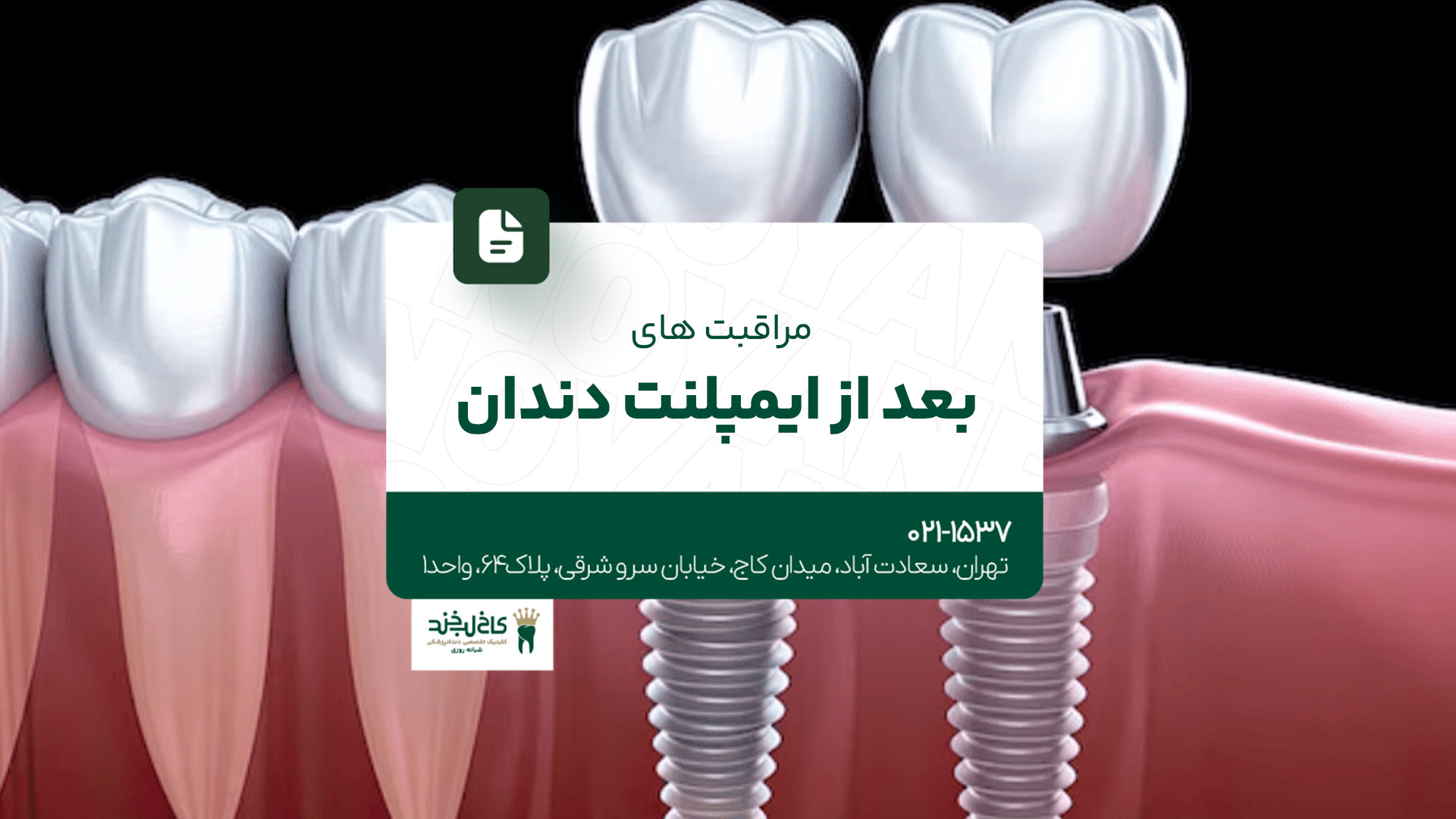 مراقبتهای بعد از ایمپلنت دندان