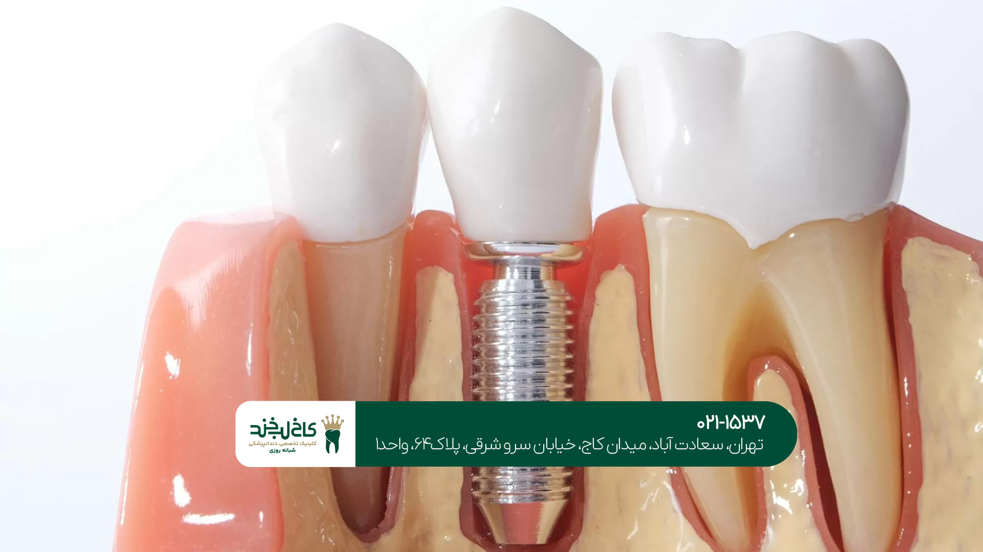 مراقبتهای بعد از ایمپلنت دندان مراقبتهای بعد از ایمپلنت دندان