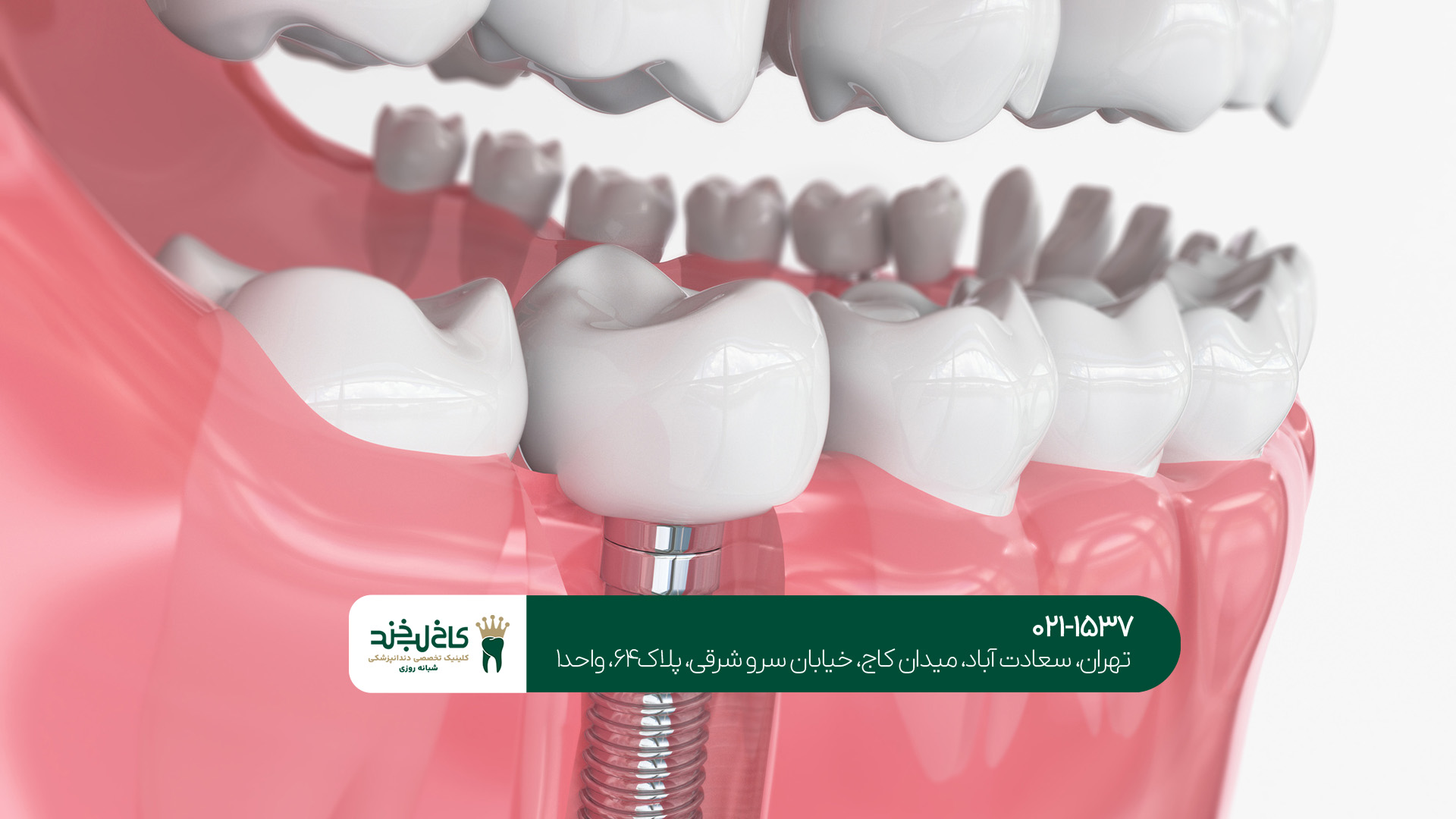 مراقبتهای بعد از ایمپلنت دندان مراقبتهای بعد از ایمپلنت دندان