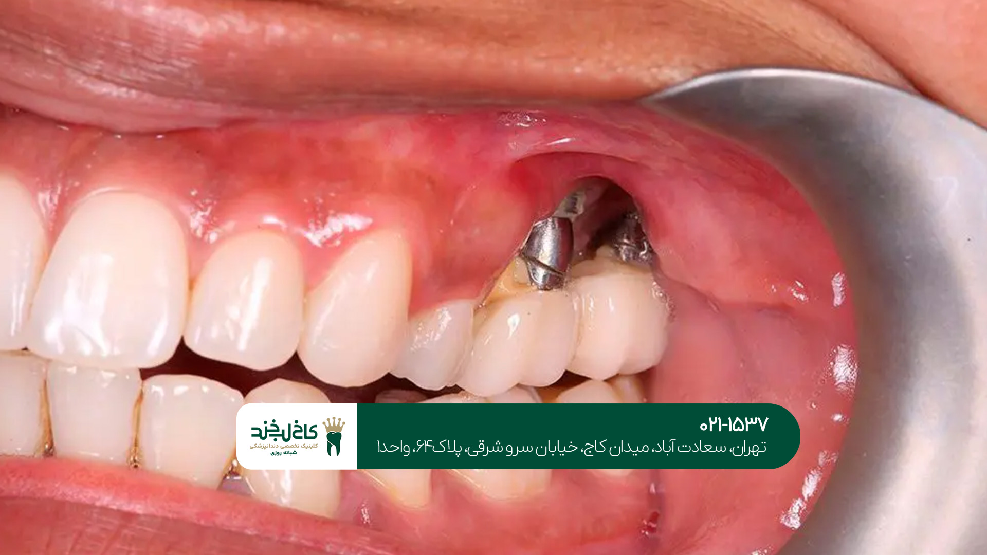 مرکز ایمپلنت یک روزه در تهران