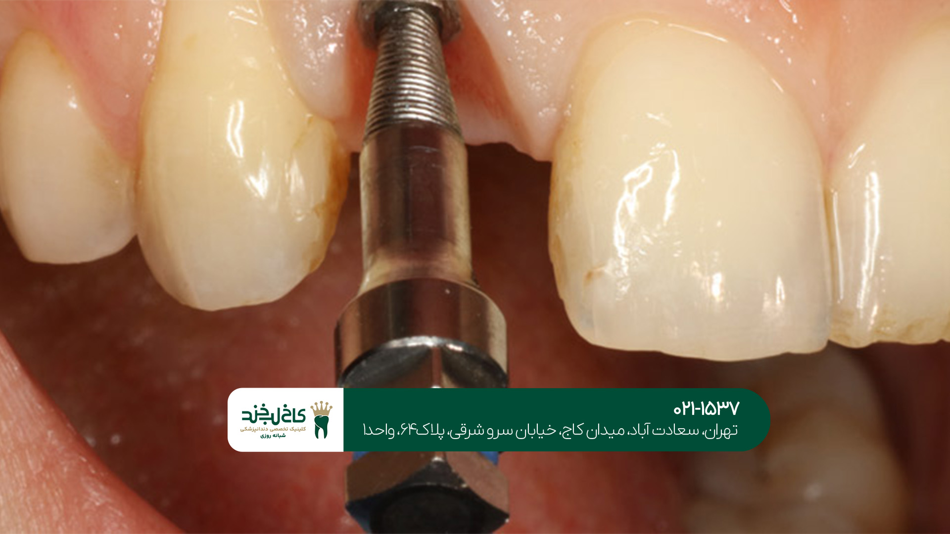 مرکز تخصصی ایمپلنت