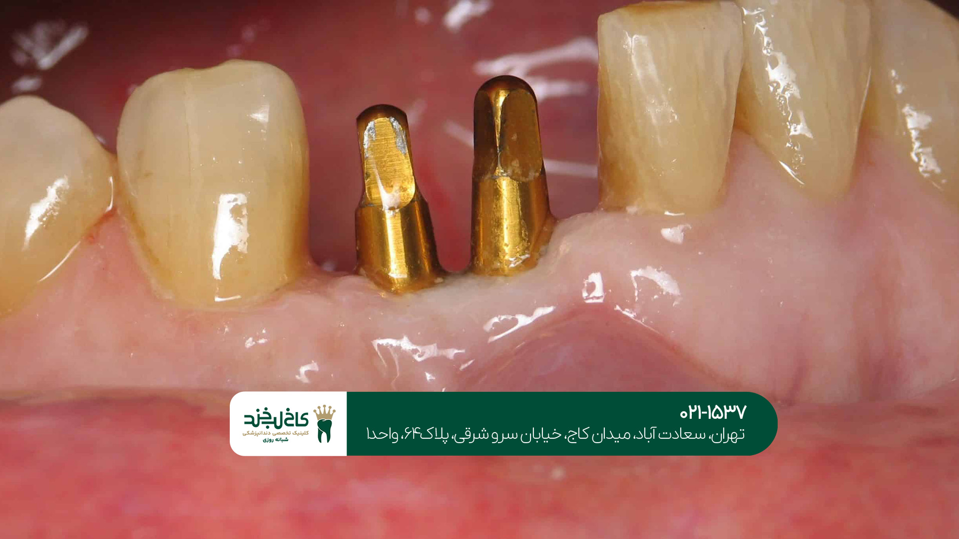 مرکز تخصصی ایمپلنت