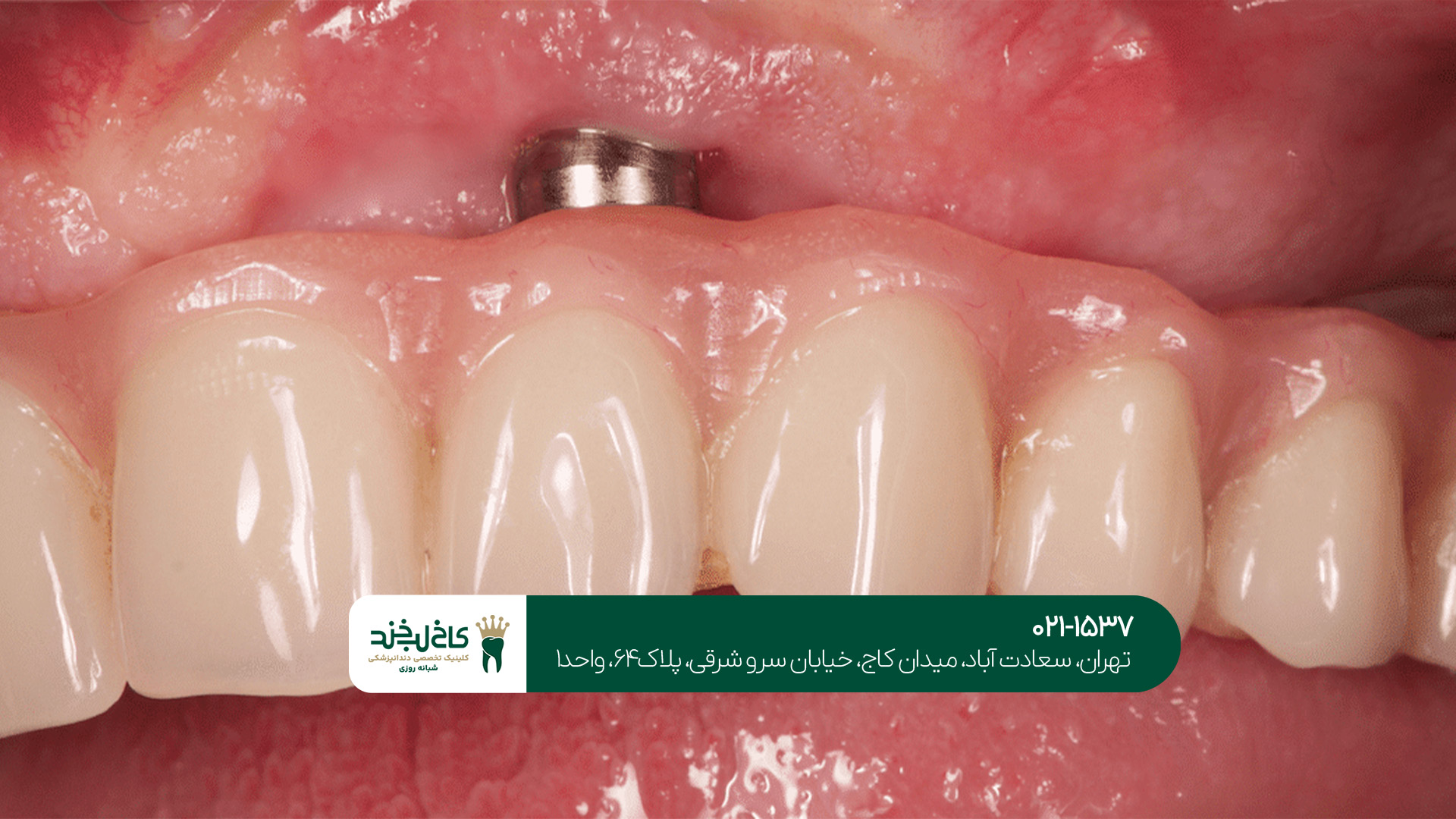 مرکز تخصصی ایمپلنت