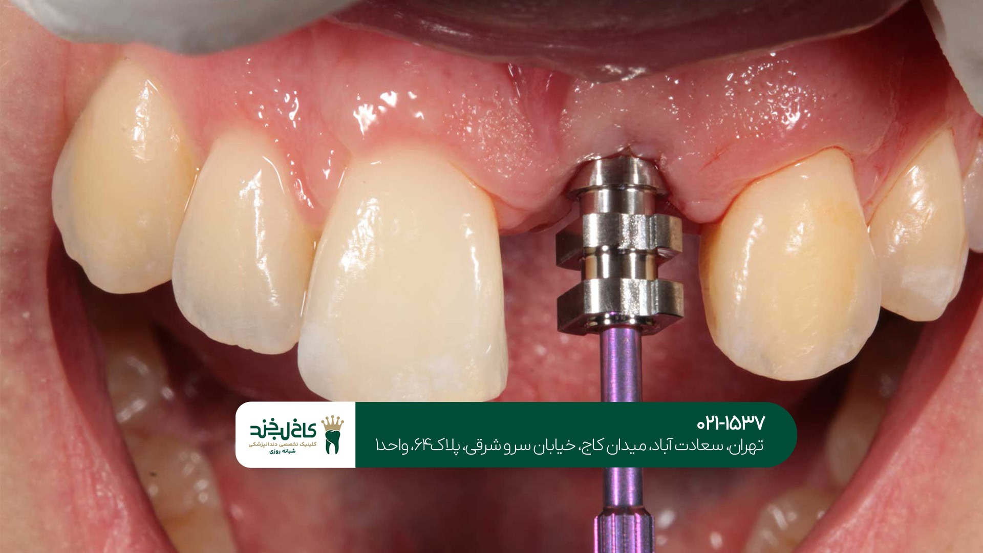  مرکز تخصصی ایمپلنت فوری دندان