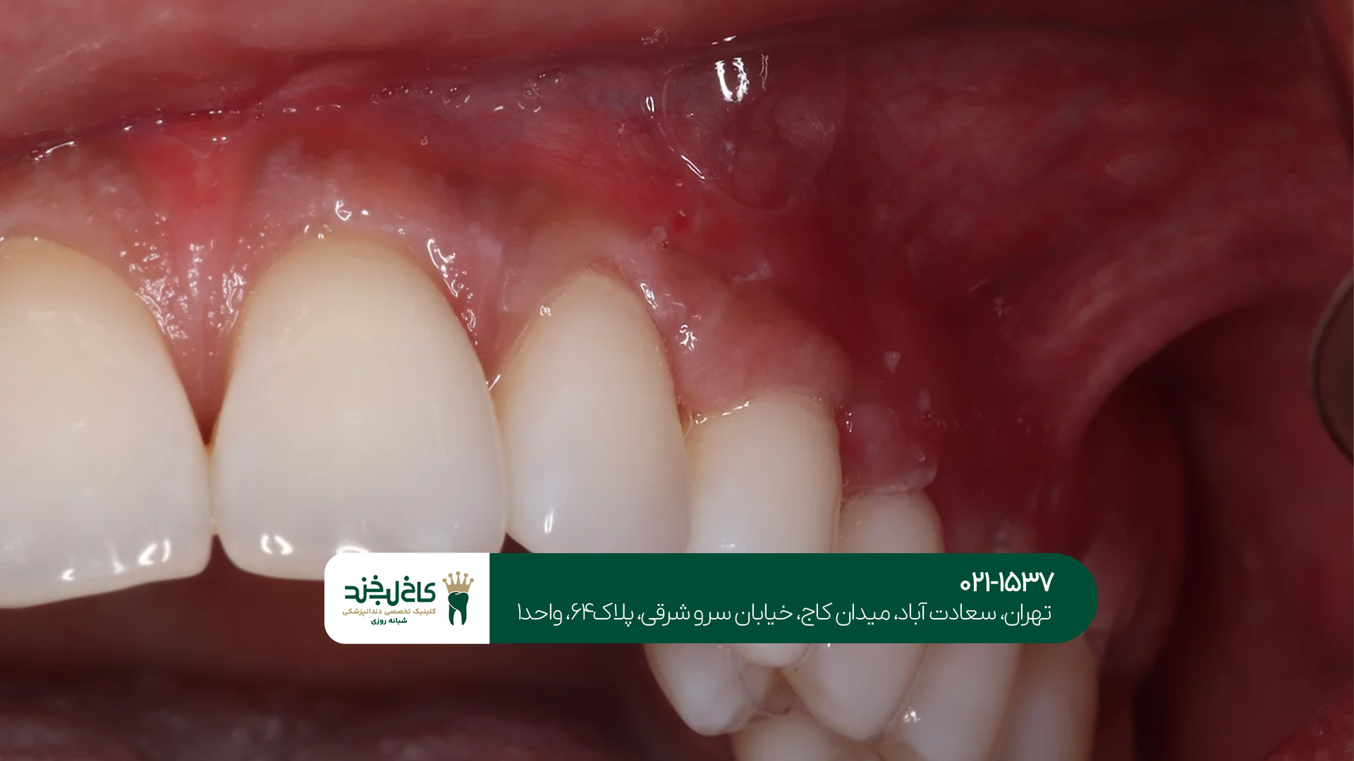  مرکز تخصصی ایمپلنت فوری دندان