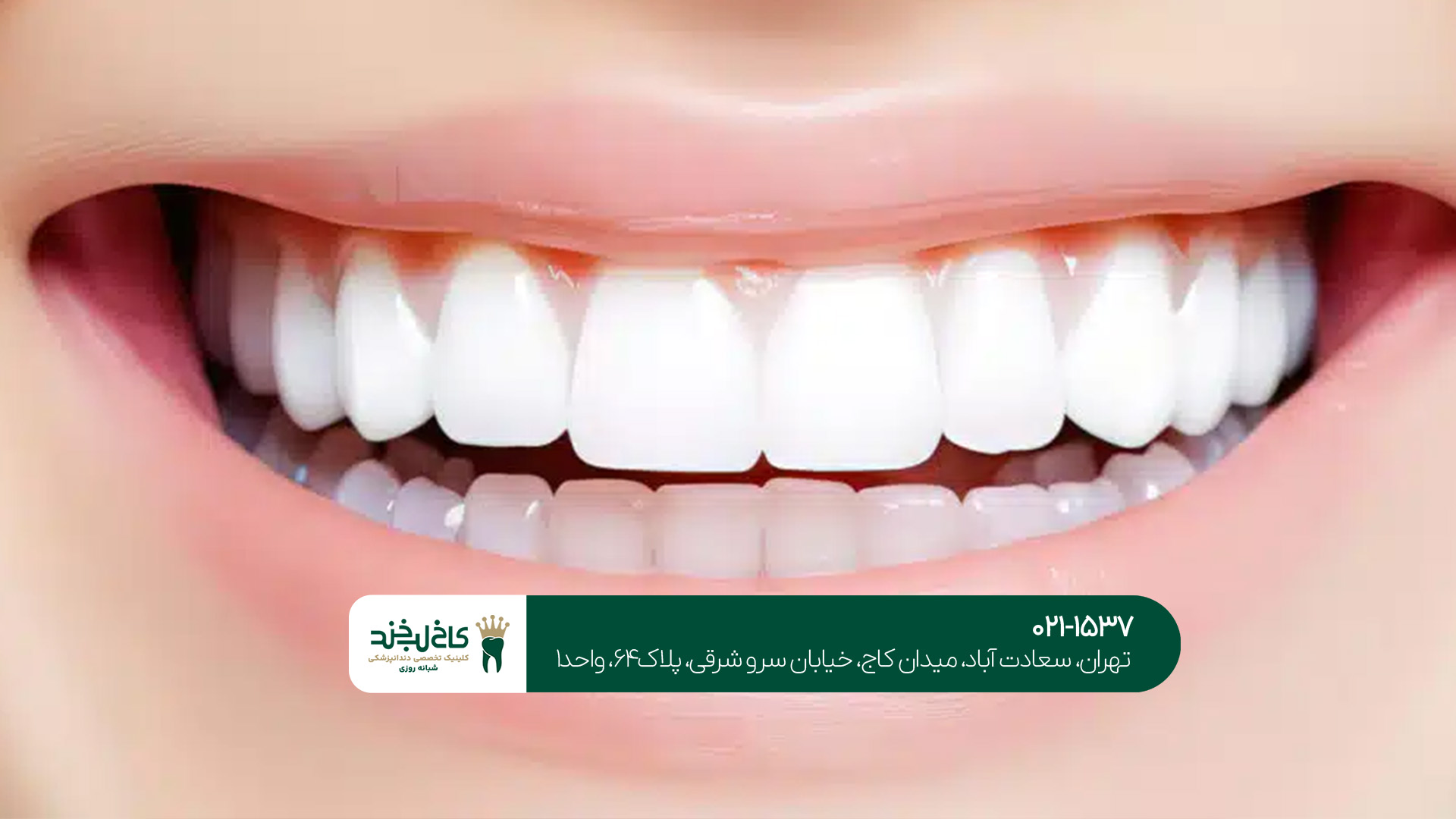 مرکز تخصصی طراحی لبخند طبیعی مرکز تخصصی طراحی لبخند طبیعی