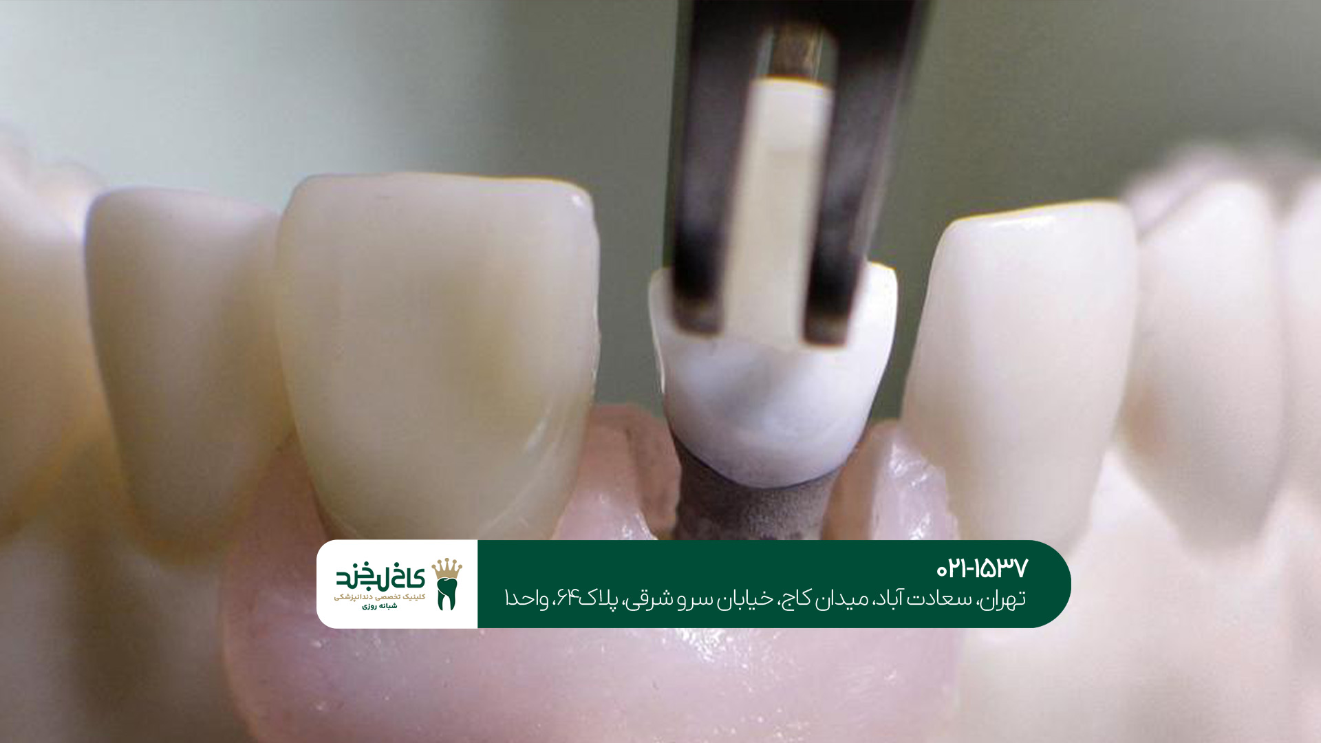 مرکز ایمپلنت بدون درد در شمال تهران مرکز ایمپلنت بدون درد در شمال تهران