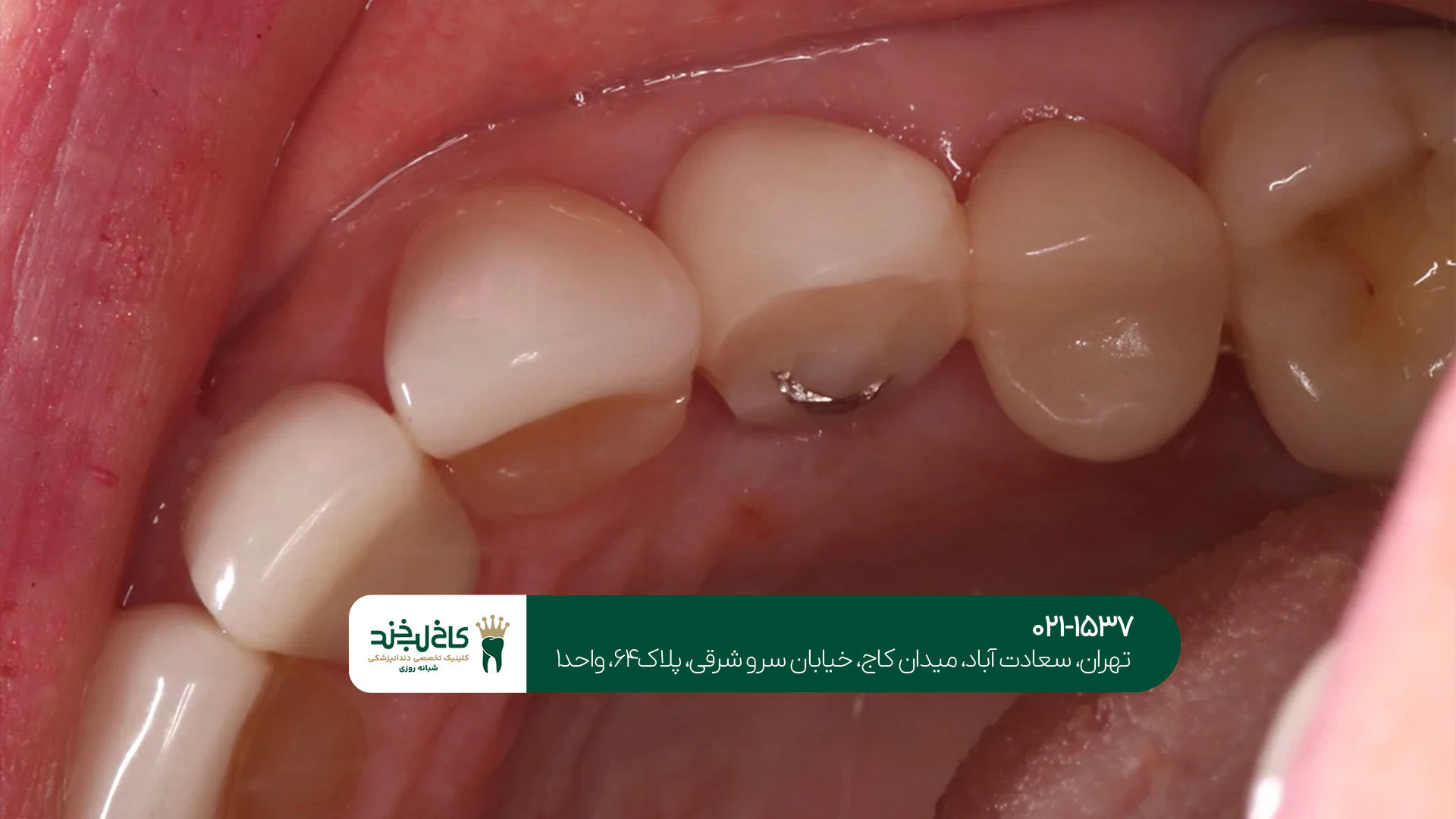  مرکز تخصصی ایمپلنت فوری دندان
