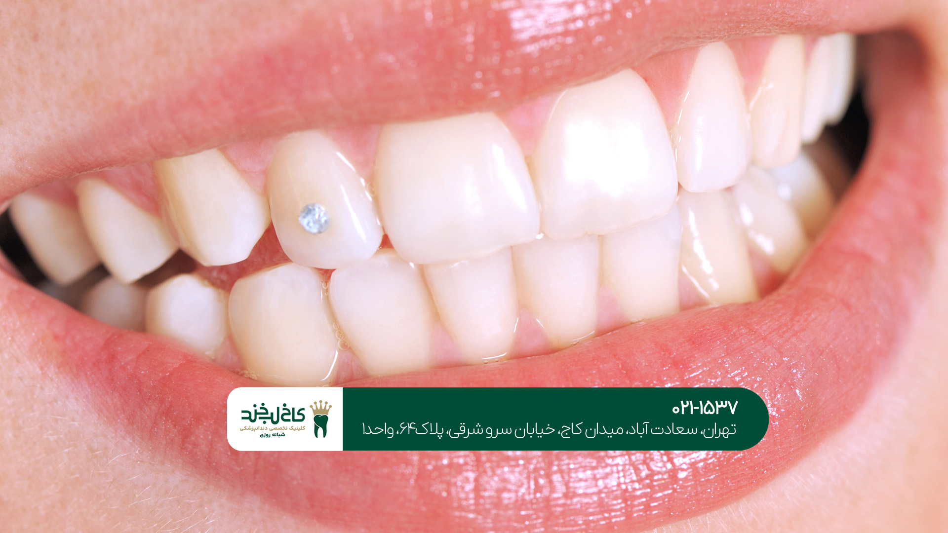 بلیچینگ دندان