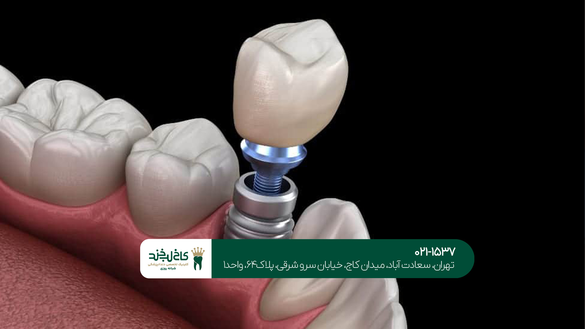 مرکز دندانپزشکی ایمپلنت در مرکز تهران مرکز دندانپزشکی ایمپلنت در مرکز تهران