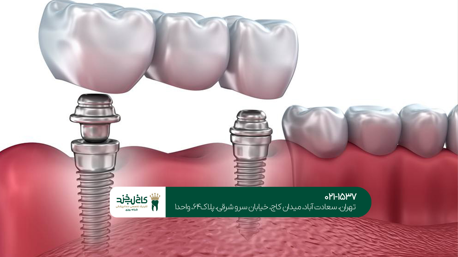 مرکز دندانپزشکی ایمپلنت در مرکز تهران مرکز دندانپزشکی ایمپلنت در مرکز تهران
