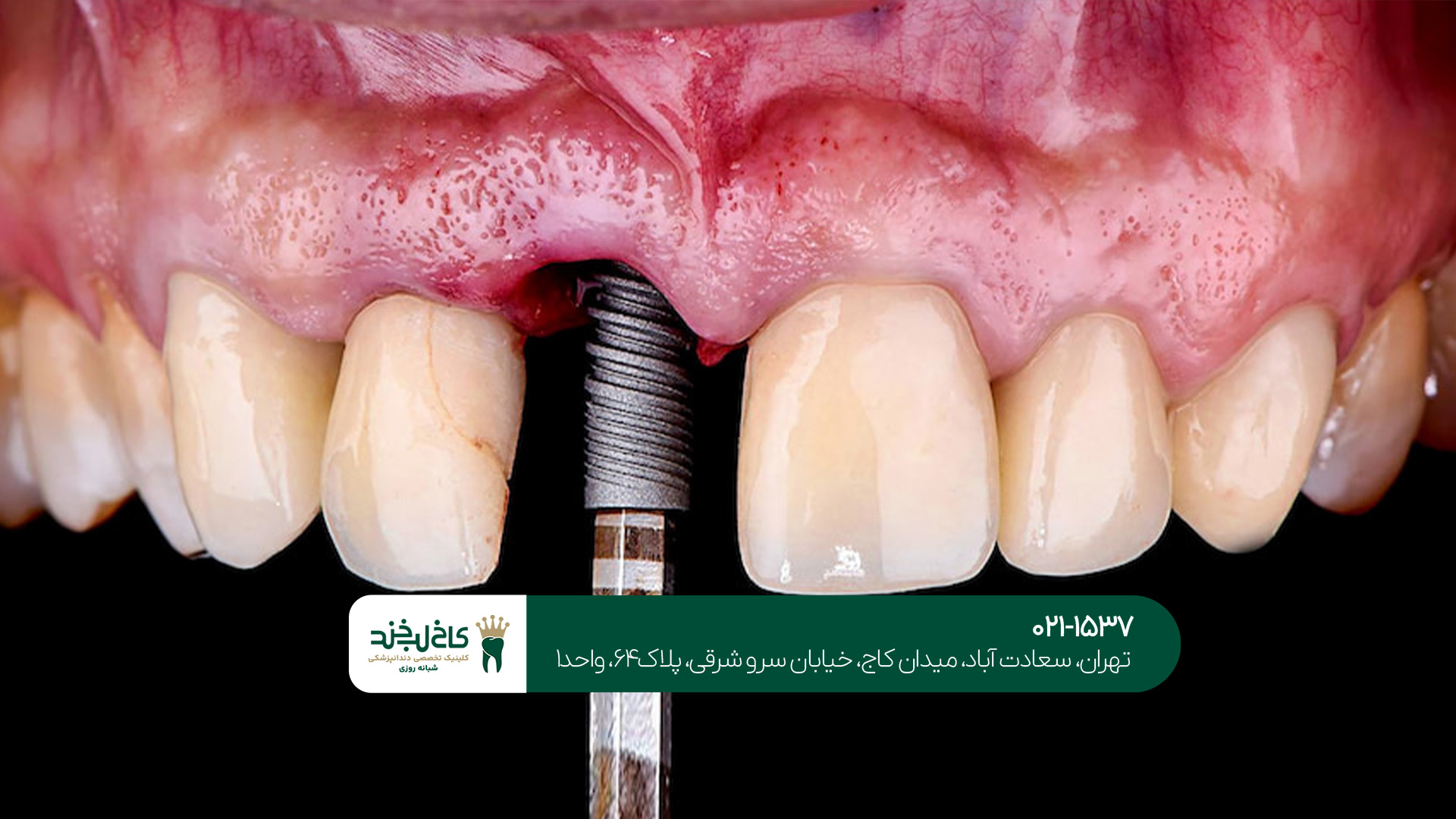 مرکز دندانپزشکی ایمپلنت در مرکز تهران مرکز دندانپزشکی ایمپلنت در مرکز تهران