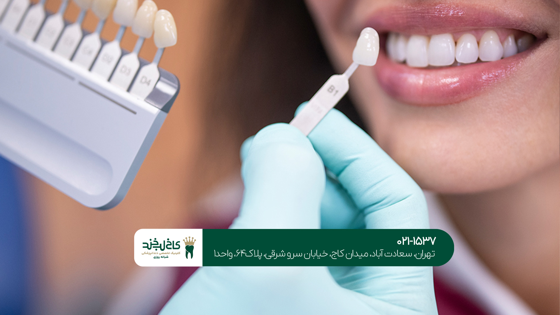 مزایای انجام کامپوزیت دندان