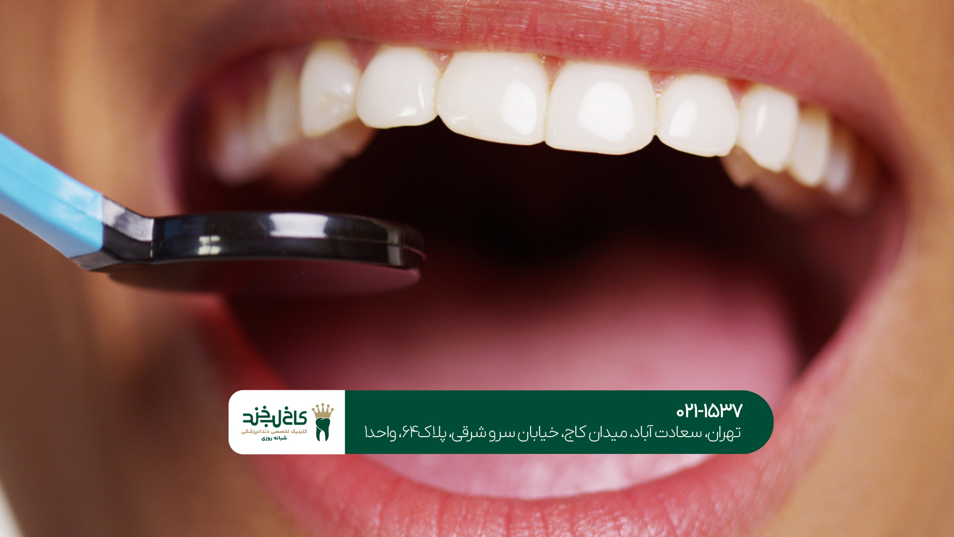 کامپوزیت دندان در جنوب تهران کامپوزیت دندان در جنوب تهران