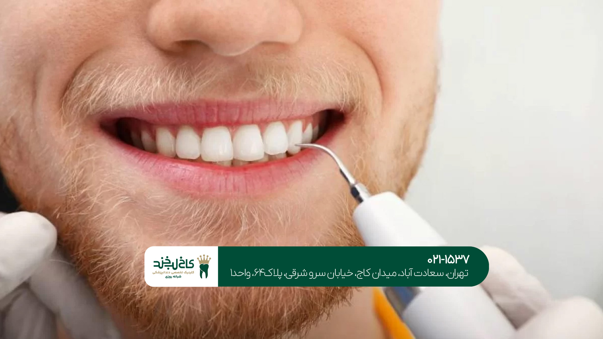 کامپوزیت دندان در جنوب تهران کامپوزیت دندان در جنوب تهران