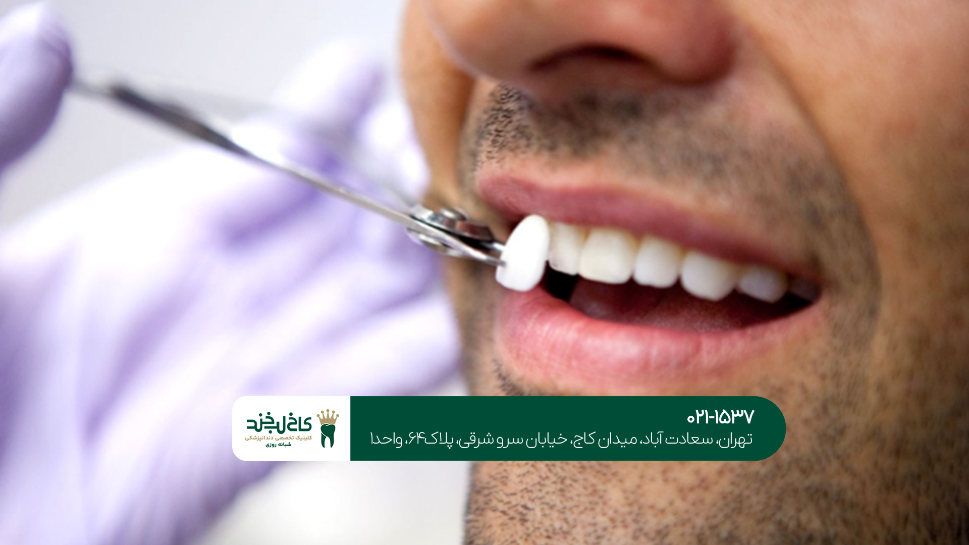 کامپوزیت دندان در جنوب تهران کامپوزیت دندان در جنوب تهران