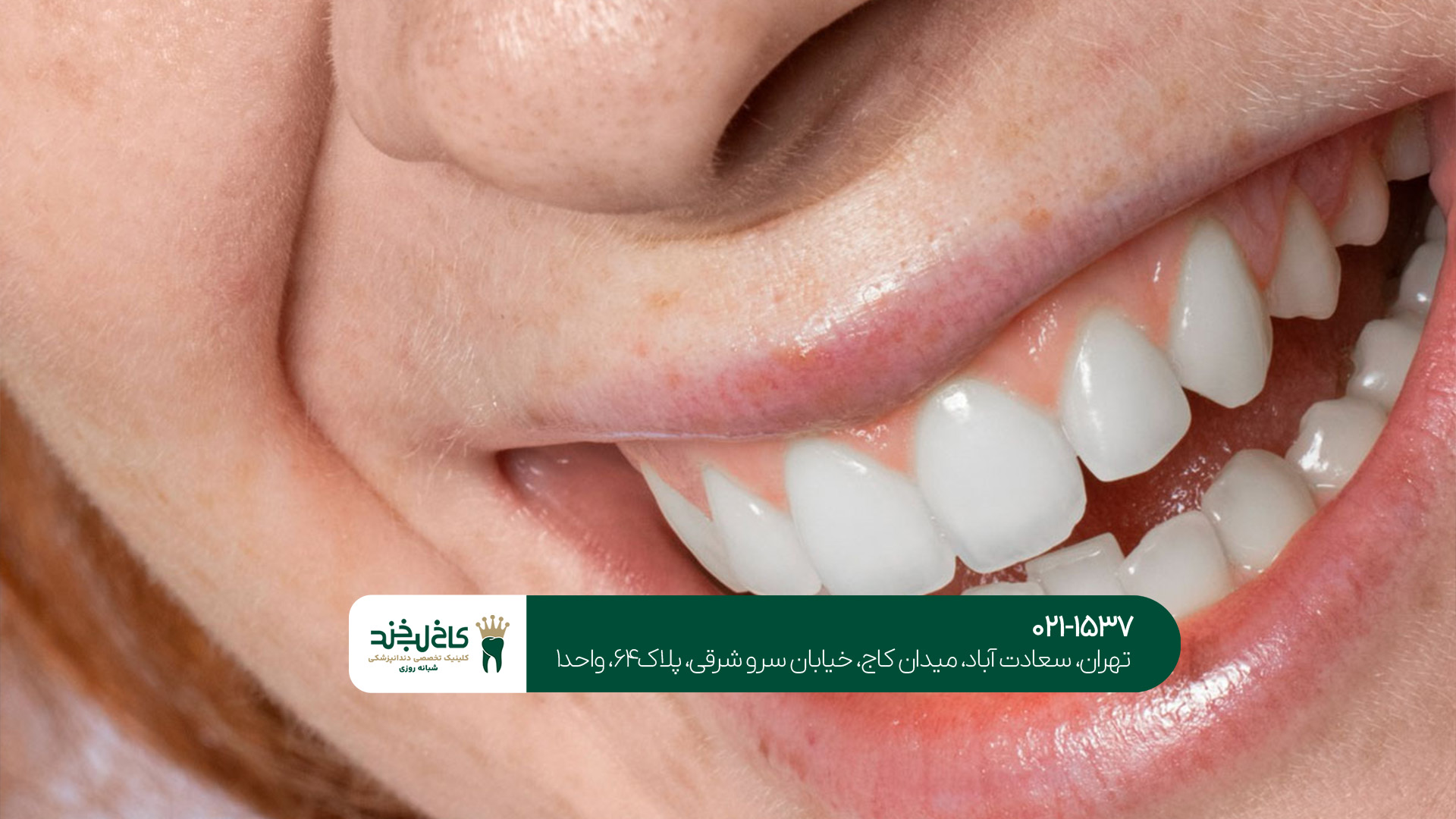 کامپوزیت دندان در غرب تهران کامپوزیت دندان در غرب تهران