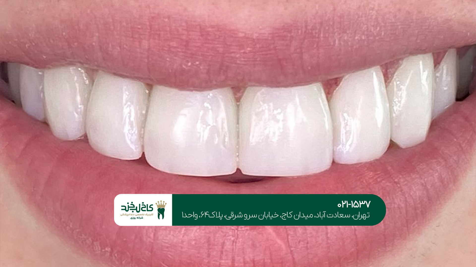 کامپوزیت دندان در غرب تهران کامپوزیت دندان در غرب تهران