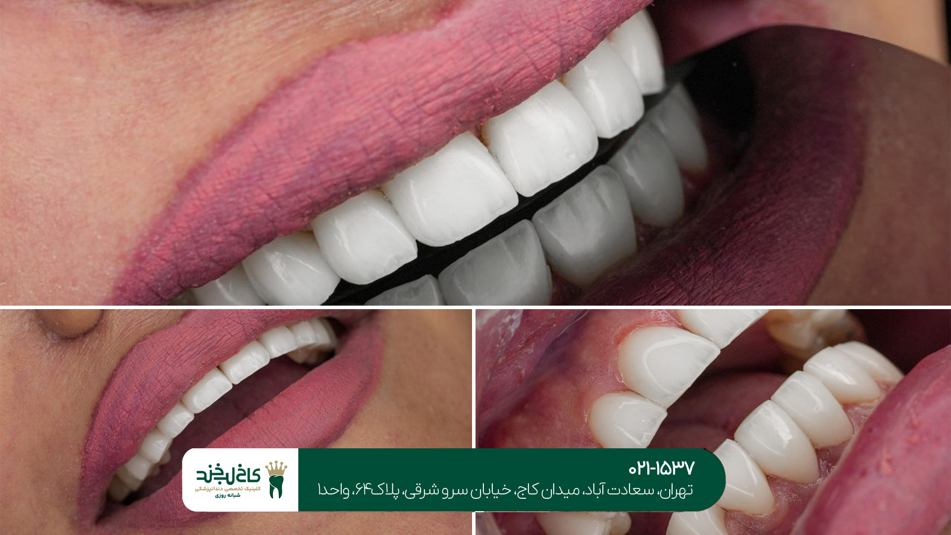 کامپوزیت دندان